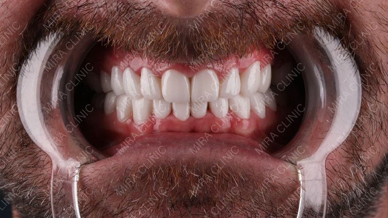 Veneers in Turkey